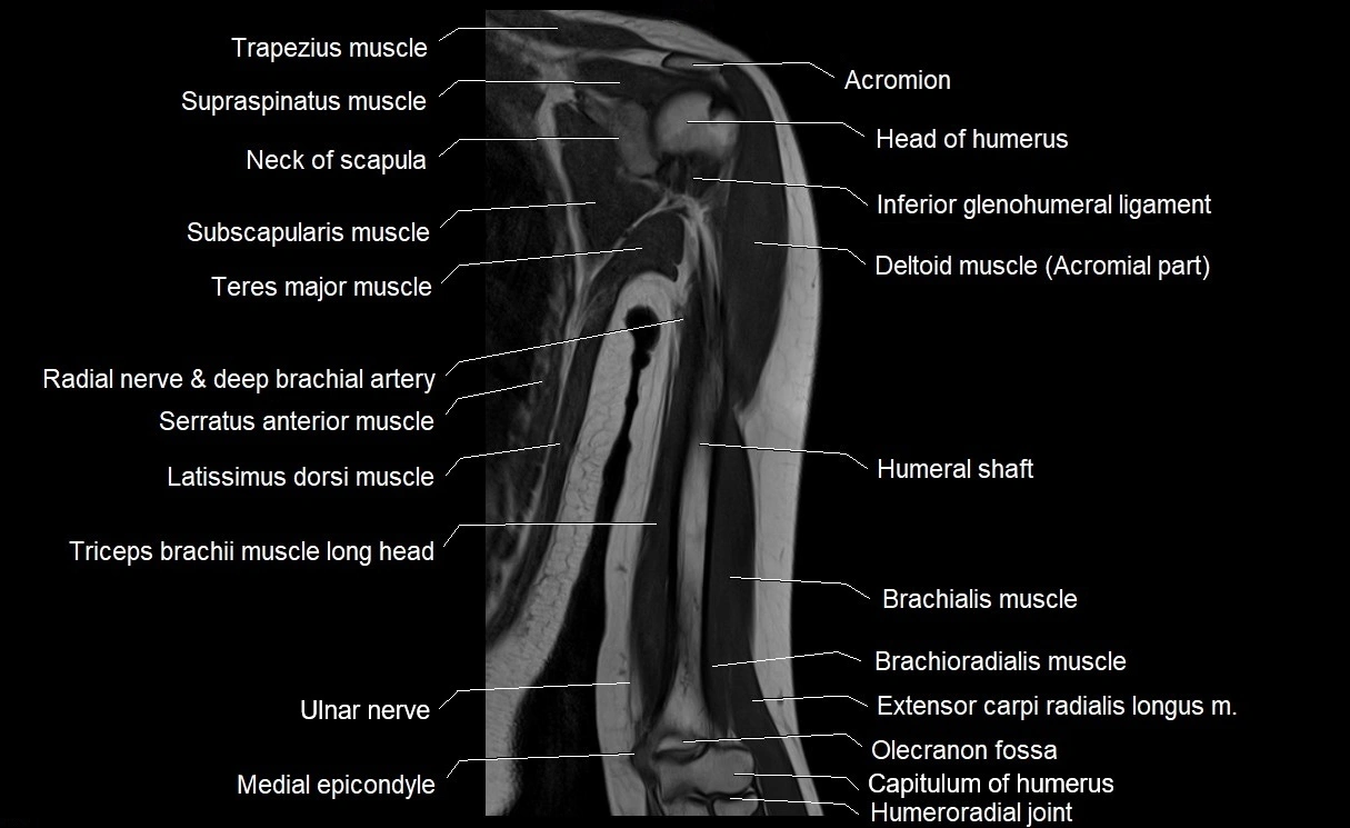 MRI upper arm (humerus ) coronal cross sectional anatomy image 16.webp
